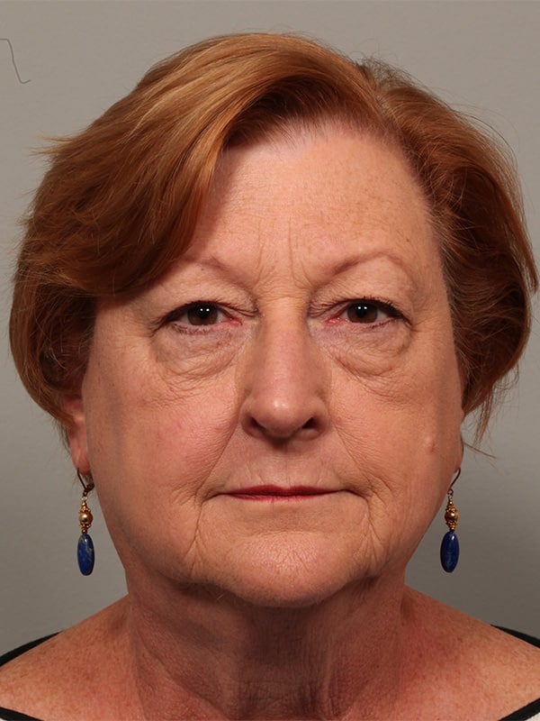Before Image: Upper & Lower Blepharoplasty - front