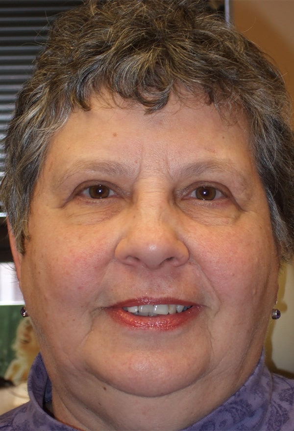 After Image: Upper Blepharoplasty - front