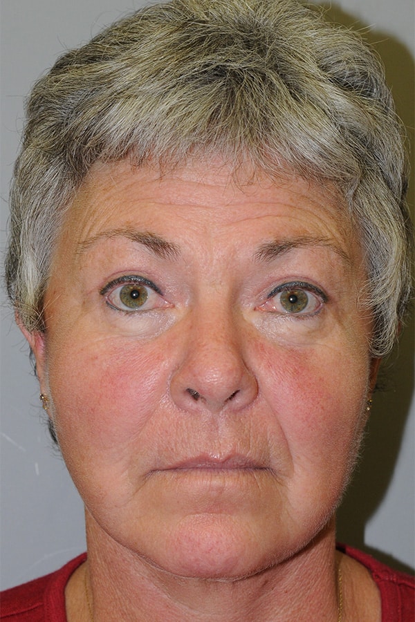 After Image: Eyelid Surgery, Facelift and Necklift - front