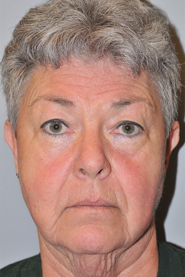 Before Image: Eyelid Surgery, Facelift and Necklift - front
