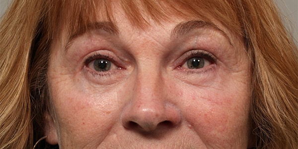 Endoscopic Browlift, Upper & Lower Blepharoplasty and Ptosis Repair