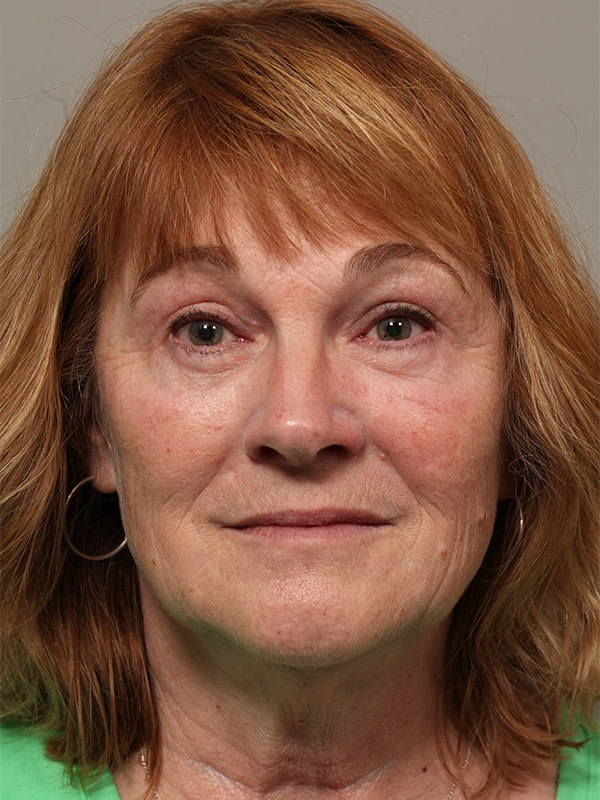 After Image: Endoscopic Browlift, Upper & Lower Blepharoplasty and Ptosis Repair - front