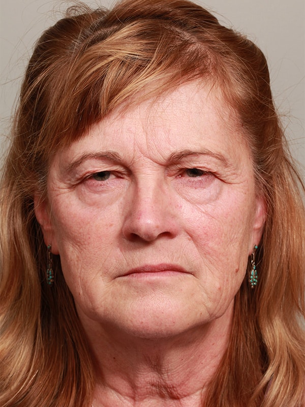Before Image: Endoscopic Browlift, Upper & Lower Blepharoplasty and Ptosis Repair - front