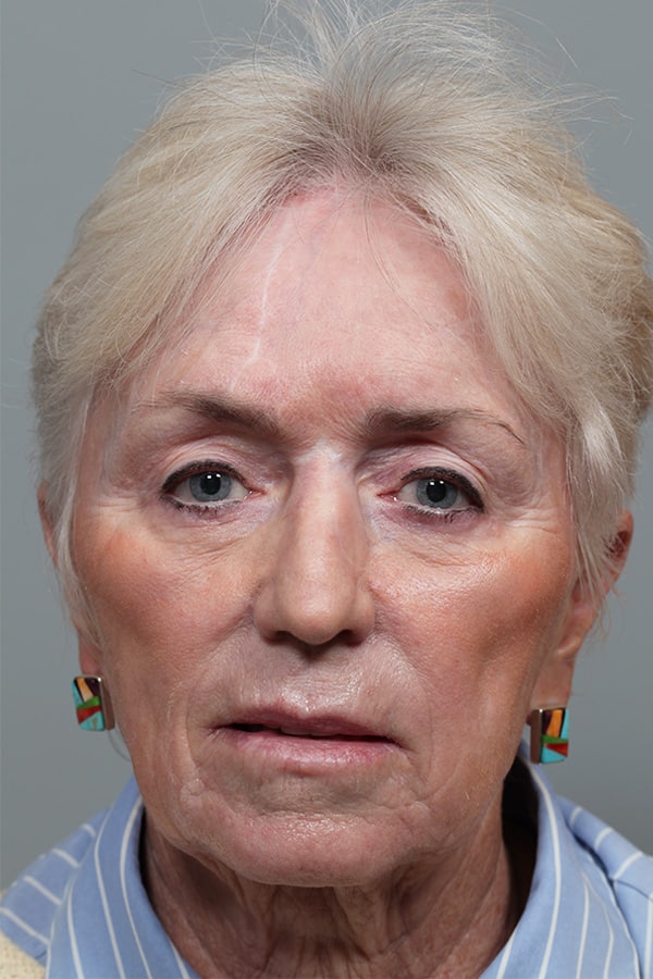 After Image: Upper and Lower Blepharoplasty with Restylane to Cheeks - front