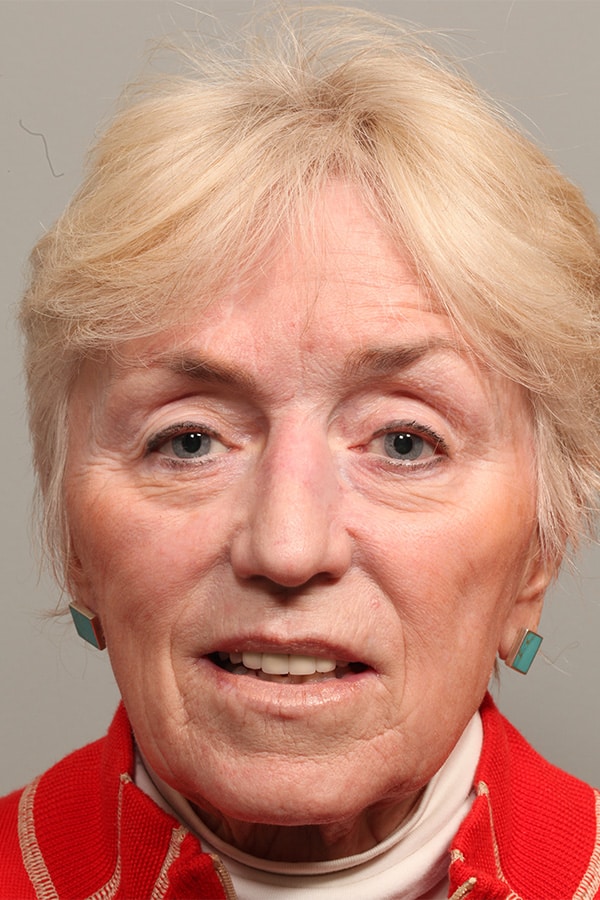 Before Image: Upper and Lower Blepharoplasty with Restylane to Cheeks - front