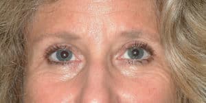 Upper & Lower Blepharoplasty