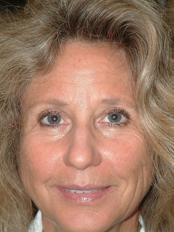 After Image: Upper & Lower Blepharoplasty - front