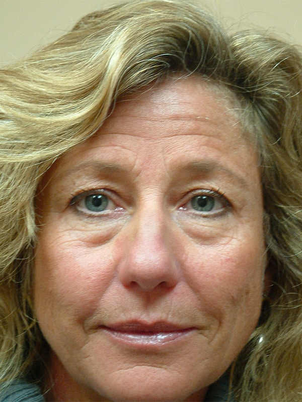 Before Image: Upper & Lower Blepharoplasty - front