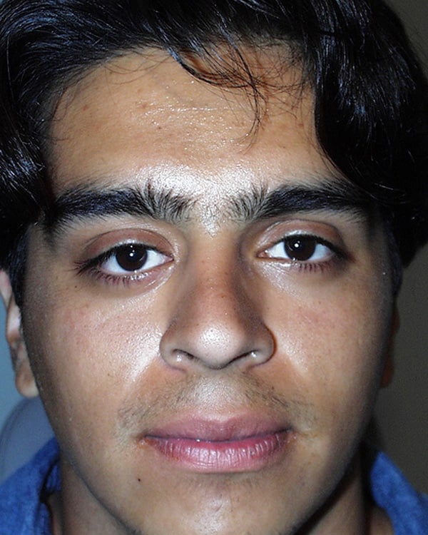 After Image: Orbital Tumor - front