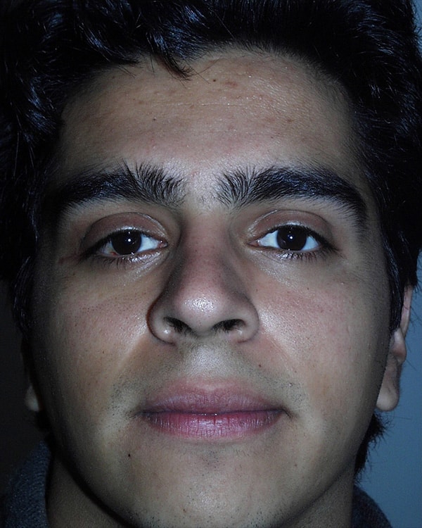 Before Image: Orbital Tumor - front
