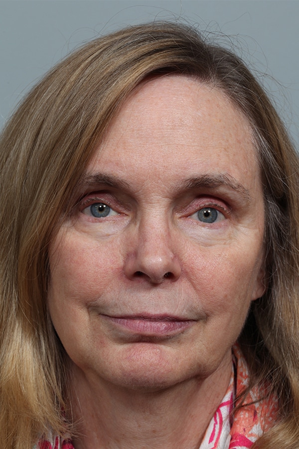 After Image: Upper Blepharoplasty and Ptosis Repair - front