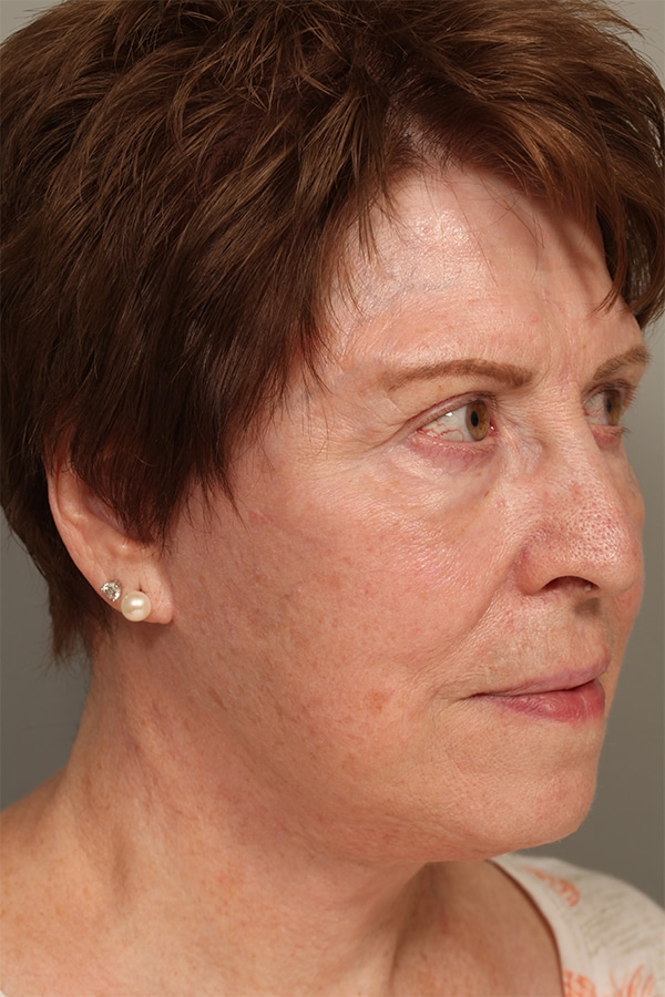 After Image: Facelift and Necklift - right-front-oblique