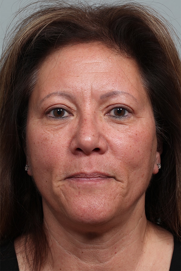 After Image: Upper Blepharoplasty - front