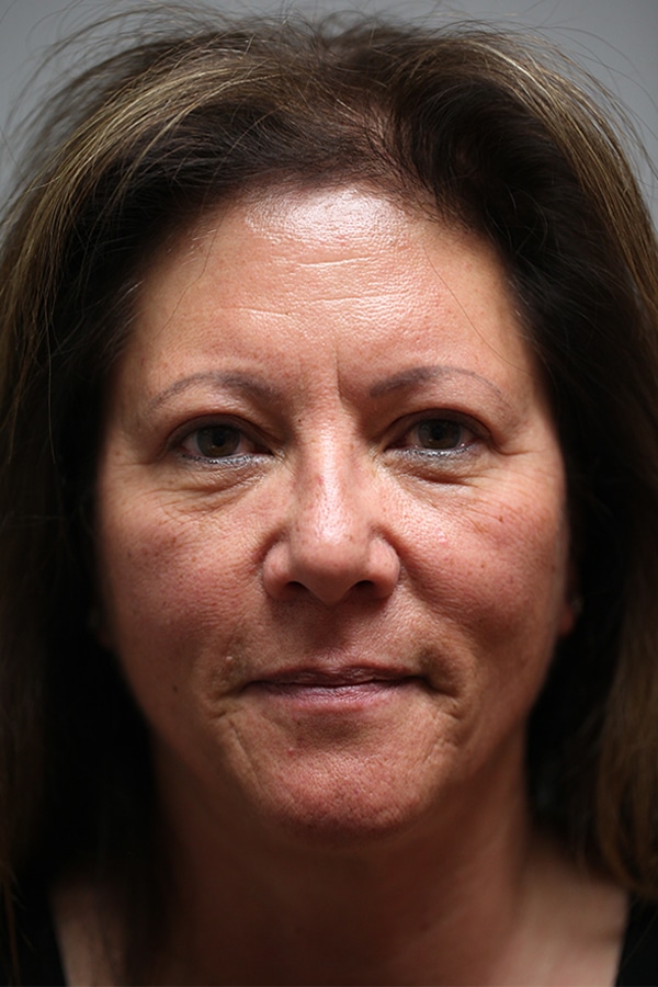After Image: Upper Blepharoplasty - front