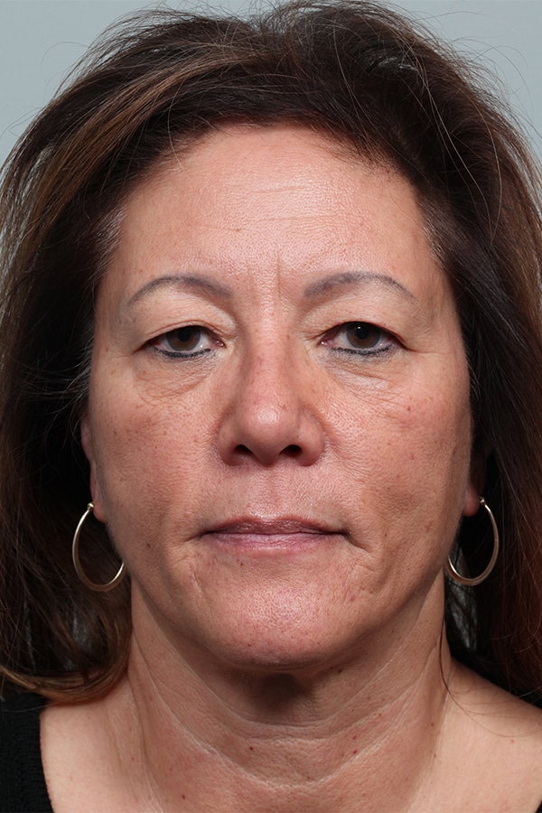 Before Image: Upper Blepharoplasty - front