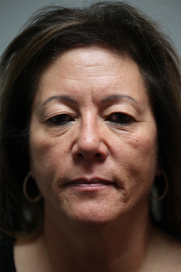 Before Image: Upper Blepharoplasty - front