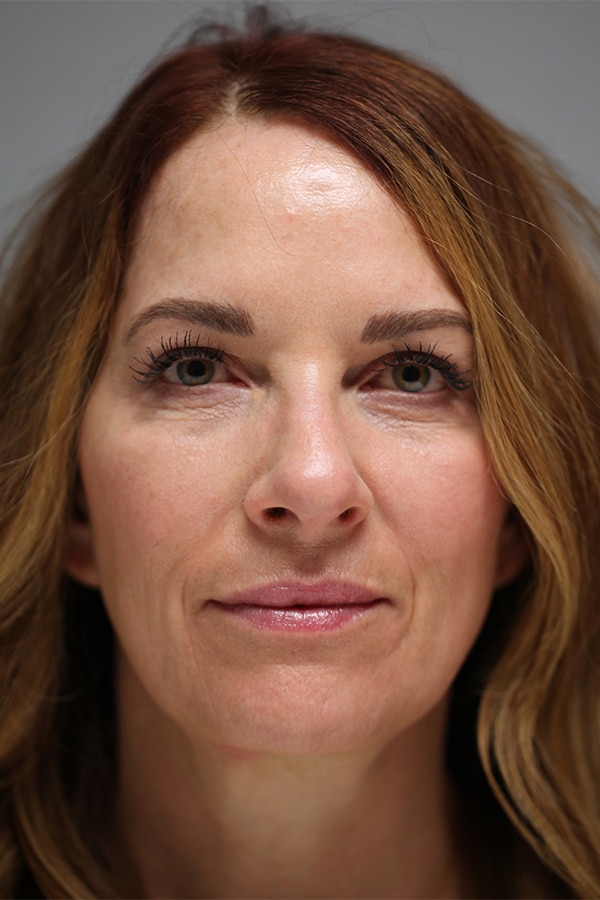After Image: Upper & Lower Blepharoplasty - front