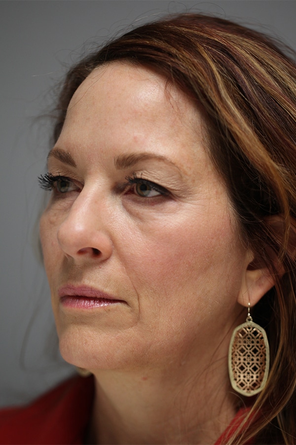Before Image: Upper & Lower Blepharoplasty - left-front-oblique