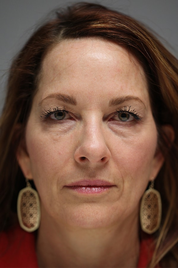 Before Image: Upper & Lower Blepharoplasty - front