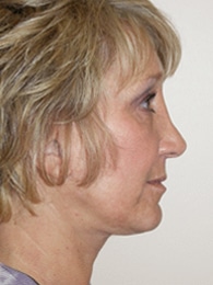 After Image: Facelift and Upper Blepharoplasty - front