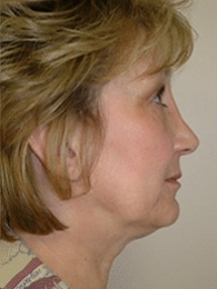 Before Image: Facelift and Upper Blepharoplasty - front
