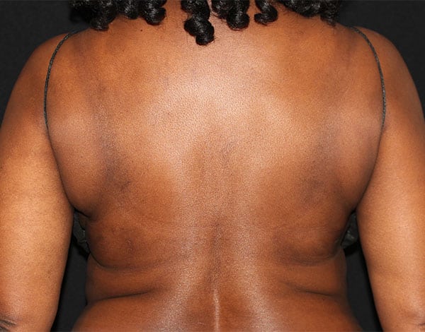 After Image: Allura Laser assisted Lipo to Bra Fat Area - front