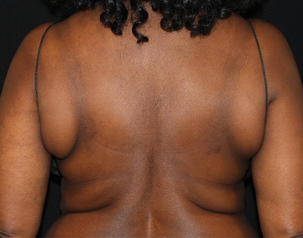 Before Image: Allura Laser assisted Lipo to Bra Fat Area - front