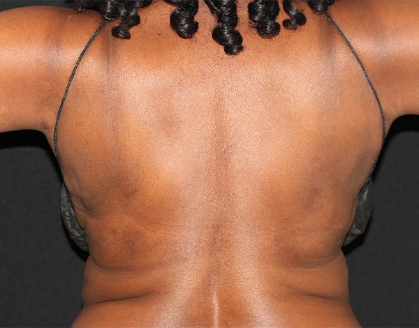 After Image: Allura Laser assisted Lipo to Bra Fat Area - front