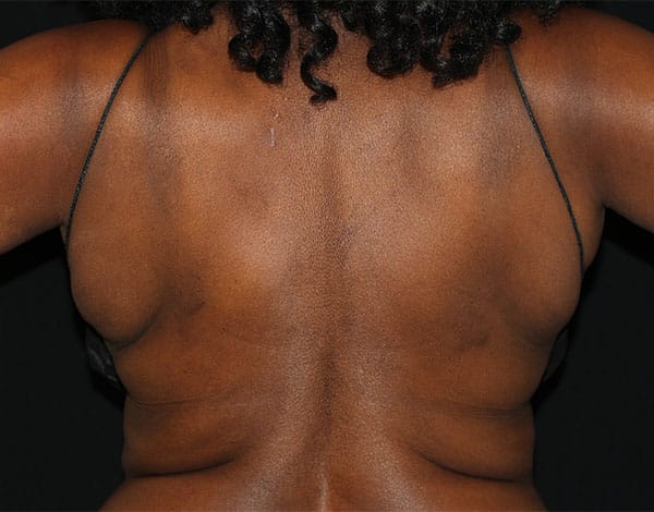 Before Image: Allura Laser assisted Lipo to Bra Fat Area - front