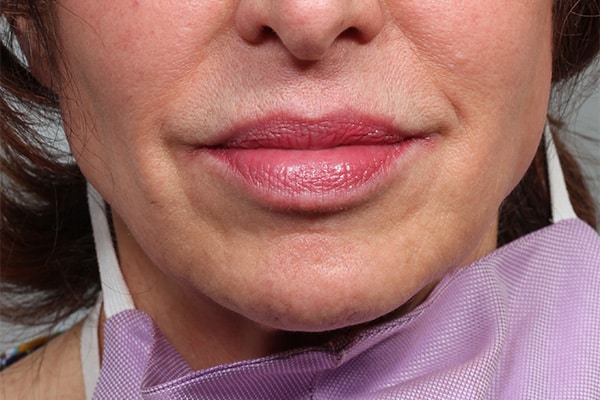 After Image: Botox and Fillers to Improve Chin & Jowl Area - front