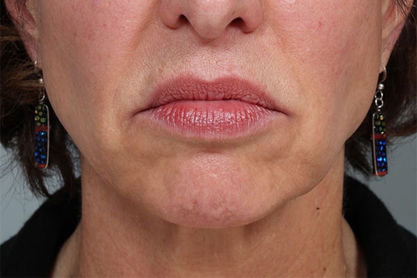 Before Image: Botox and Fillers to Improve Chin & Jowl Area - front