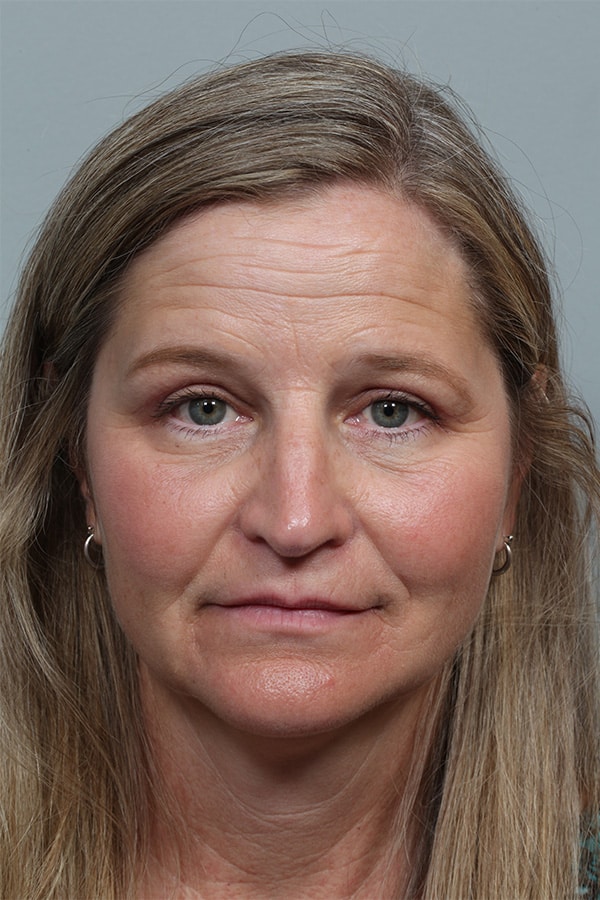 After Image: Upper Blepharoplasty and Internal Ptosis Repair - front