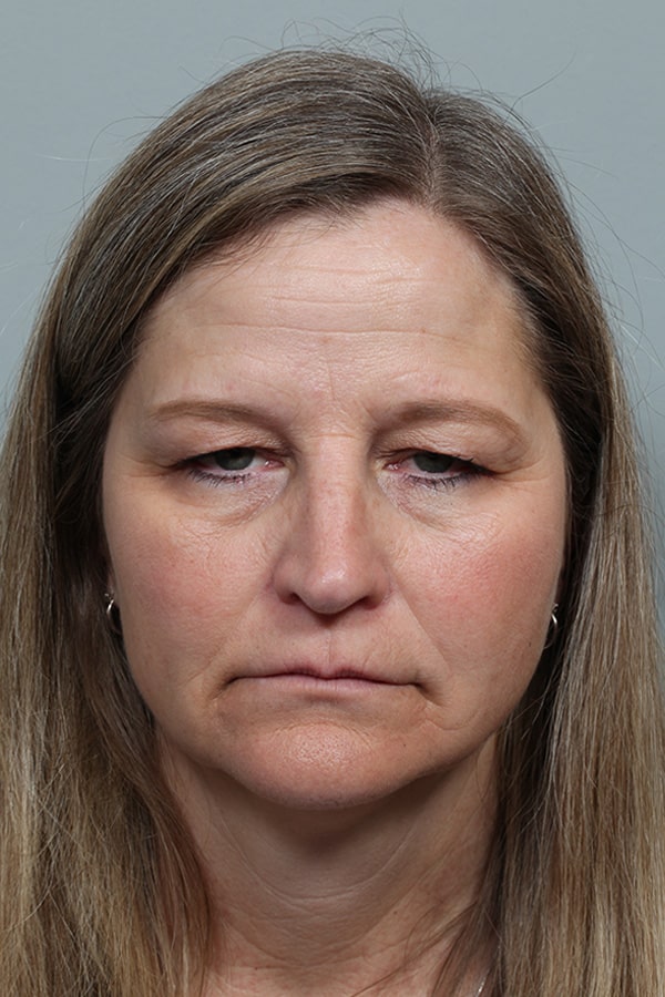 Before Image: Upper Blepharoplasty and Internal Ptosis Repair - front