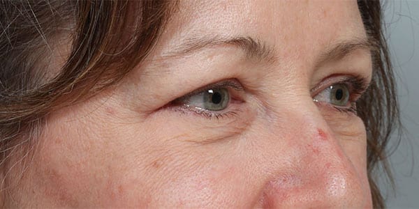 After Image: Upper & Lower Blepharoplasty and Laser Resurfacing - right-front-oblique