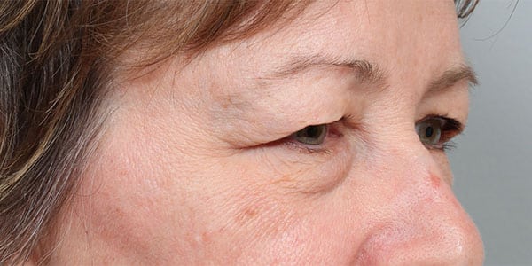 Before Image: Upper & Lower Blepharoplasty and Laser Resurfacing - right-front-oblique