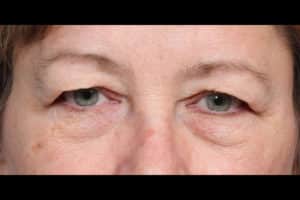 Upper & Lower Blepharoplasty and Laser Resurfacing