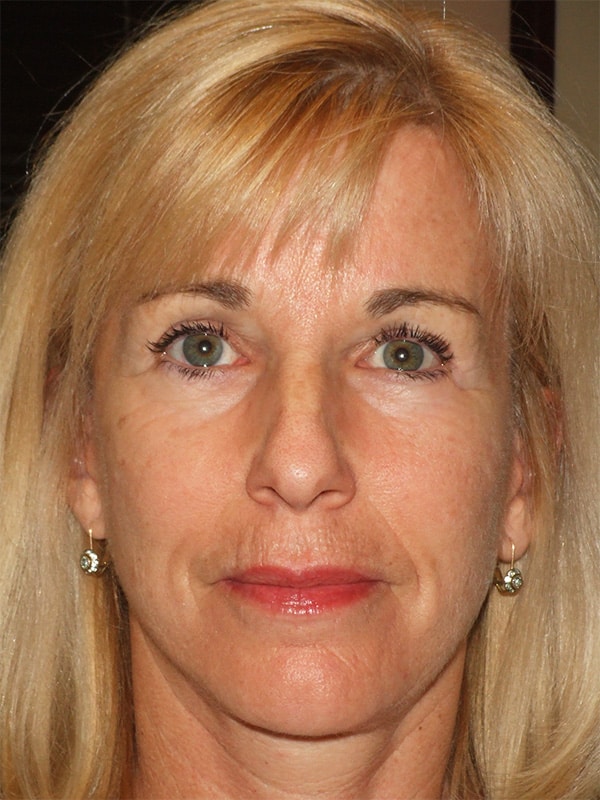 After Image: Facelift, Necklift and Lower Blepharoplasty - front