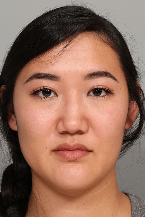 After Image: Asian Blepharoplasty - front