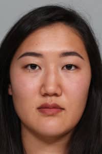 Asian Blepharoplasty