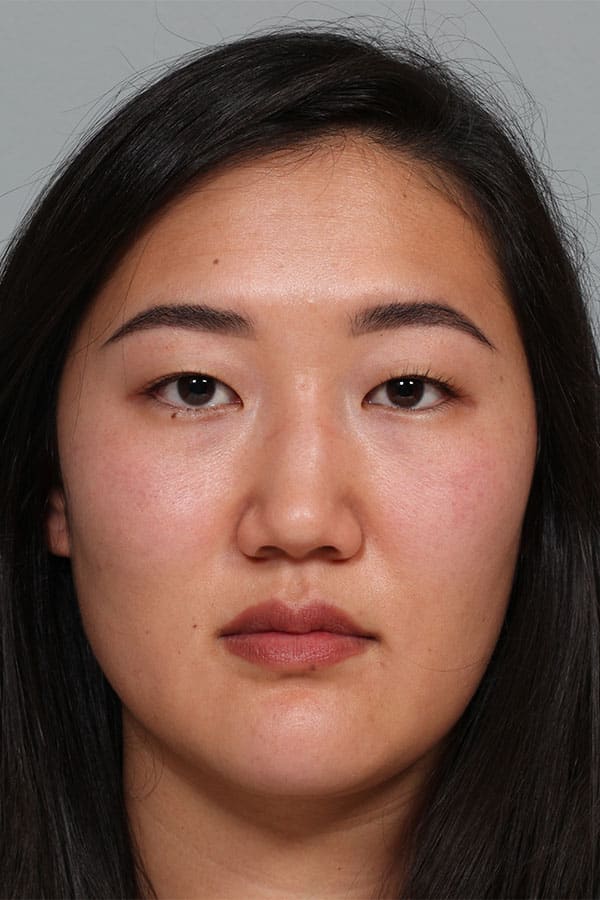 Before Image: Asian Blepharoplasty - front