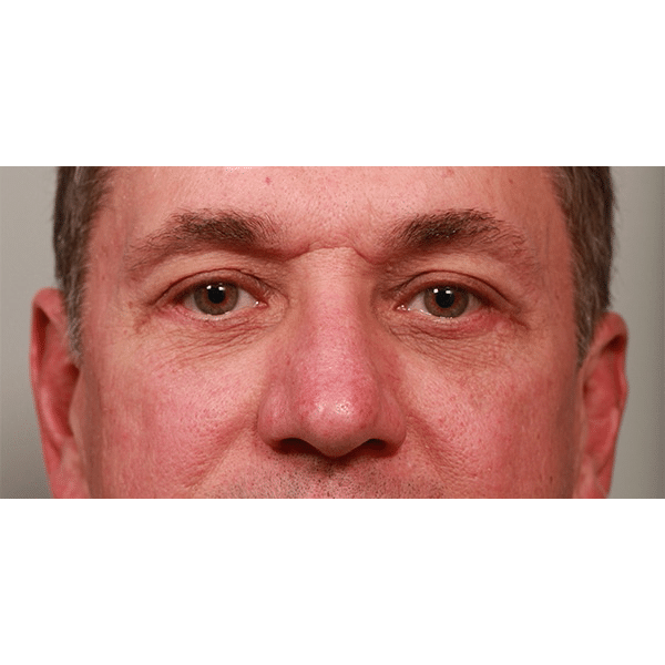 After Image: Lower Blepharoplasty - front