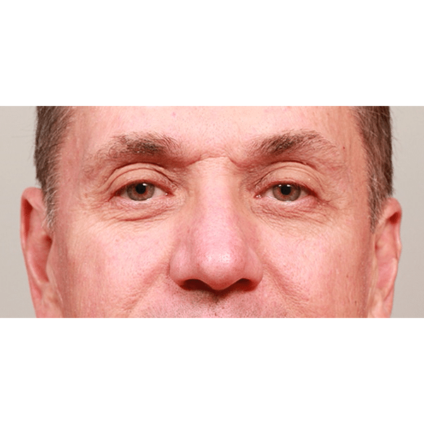 Before Image: Lower Blepharoplasty - front