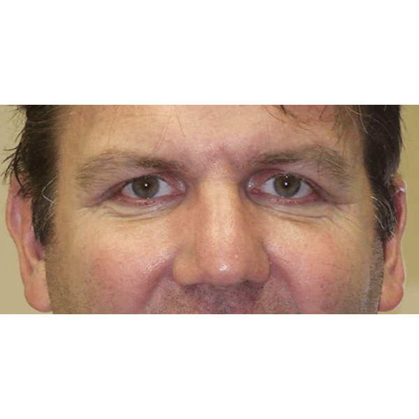 After Image: Ptosis Repair - front