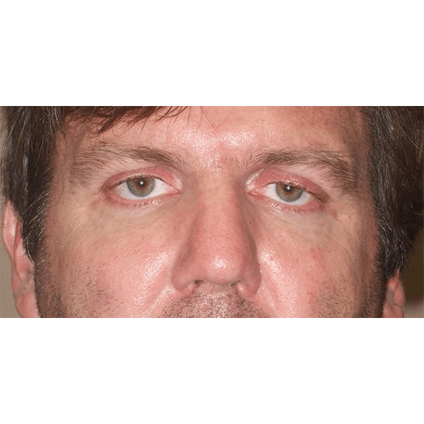 Before Image: Ptosis Repair - front