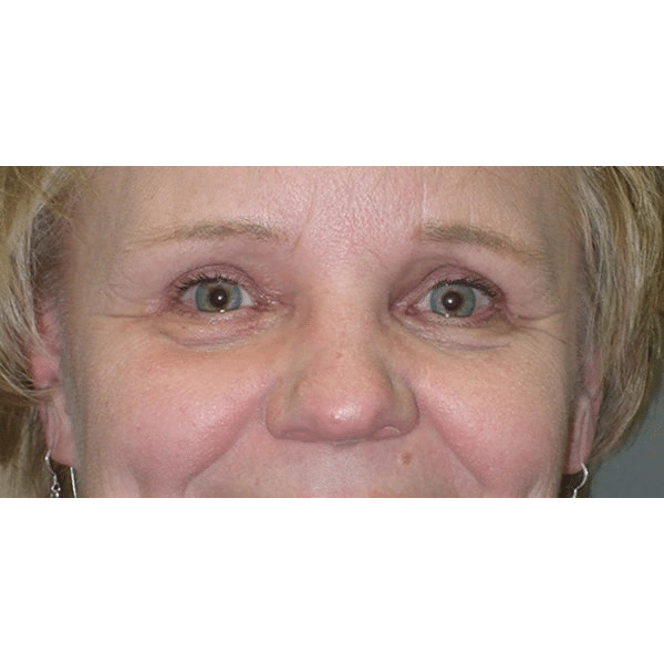 After Image: Ptosis Repair - front
