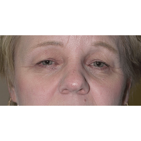 Before Image: Ptosis Repair - front
