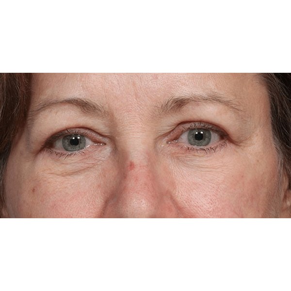 After Image: Upper & Lower Blepharoplasty and Laser Resurfacing - front