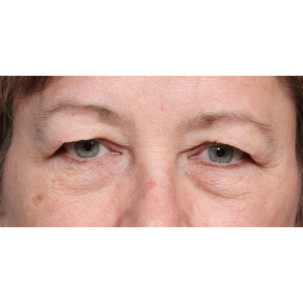 Before Image: Upper & Lower Blepharoplasty and Laser Resurfacing - front