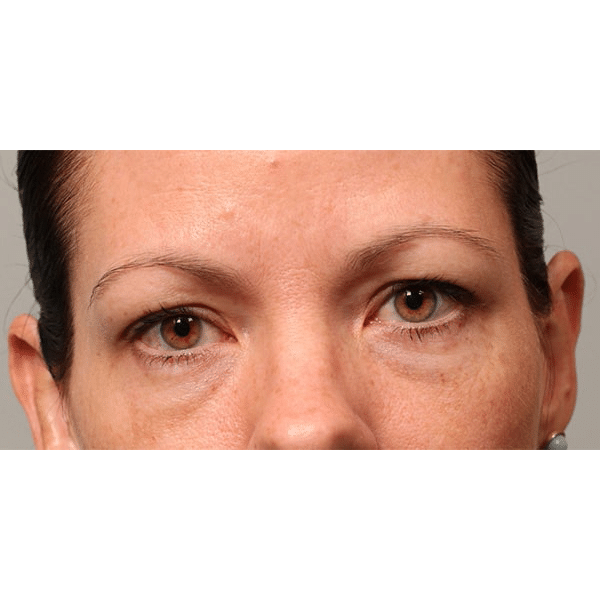 Before Image: Lower Blepharoplasty - front