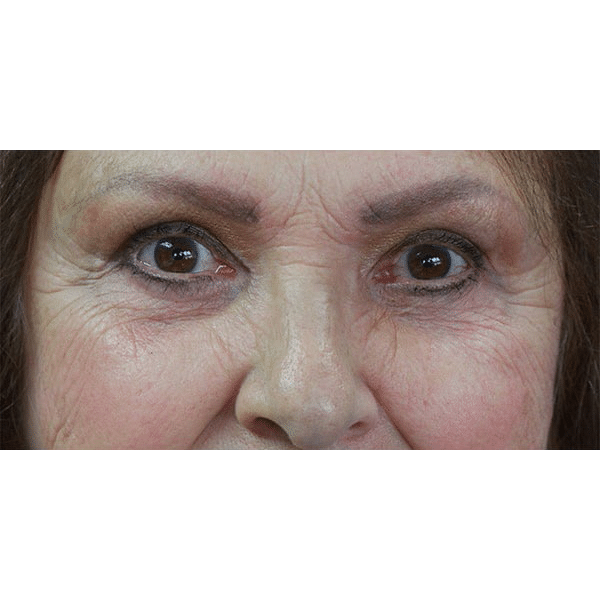 After Image: Upper and Lower Blepharoplasty - front